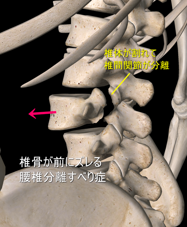 分離すべり