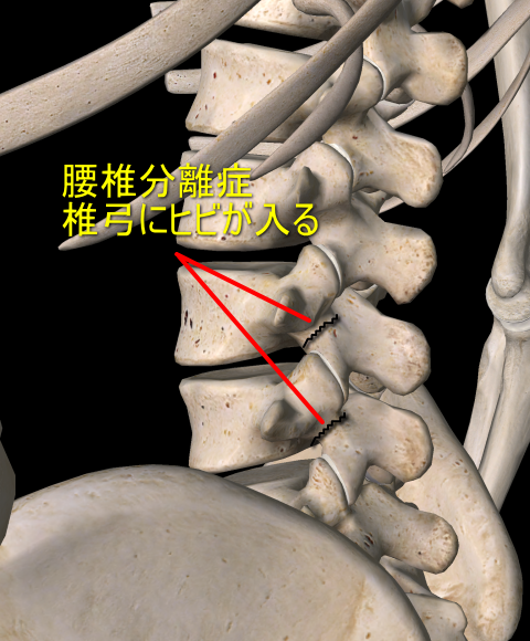 分離症