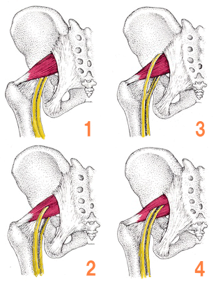 坐骨神経が骨盤から下肢に至る経路は4タイプに分類されます。