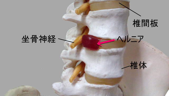 椎間板ヘルニア